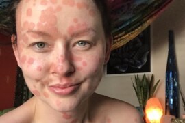 How to Live Laugh Love with Psoriasis!  Story of Aimee Grace Godden