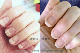She Healed Her Nail Psoriasis Naturally