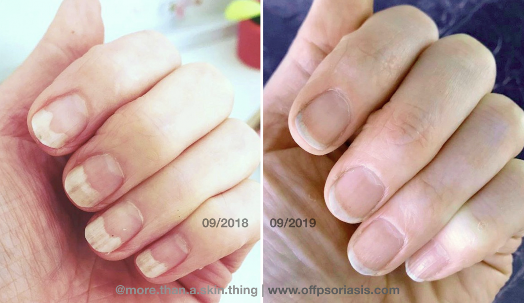 She Healed Her Nail Psoriasis Naturally | OffPsoriasis