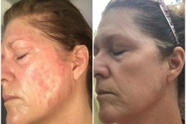 Leanne’s Psoriasis Journey