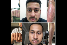 Mohammed’s Psoriasis Journey