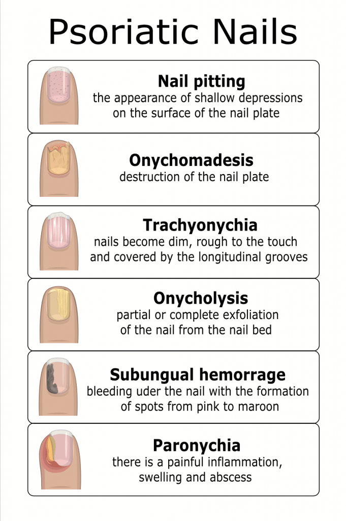 Psoriasis Types | OffPsoriasis