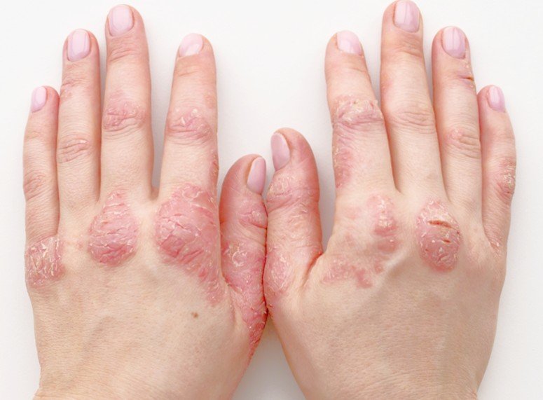 Psoriasis Types | OffPsoriasis